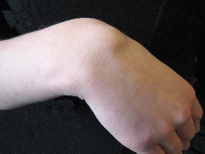 What Is Ganglion