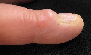 Ganglion Thumb